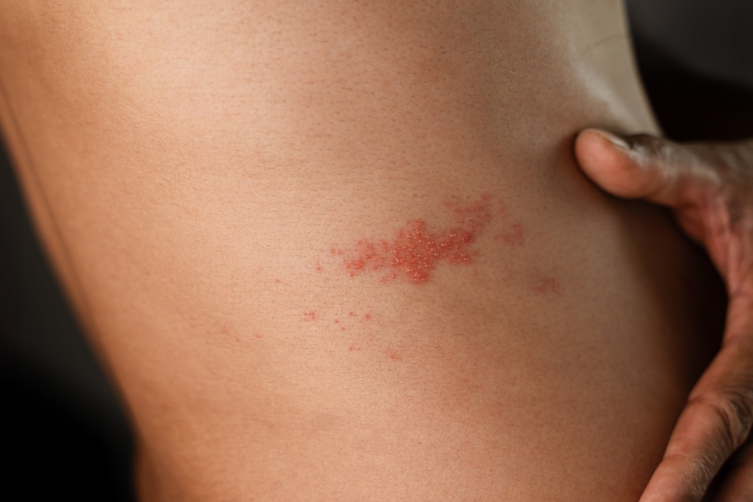 Shingles Rash